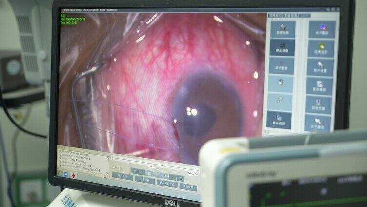眼科手术 青光眼手术 医疗治疗