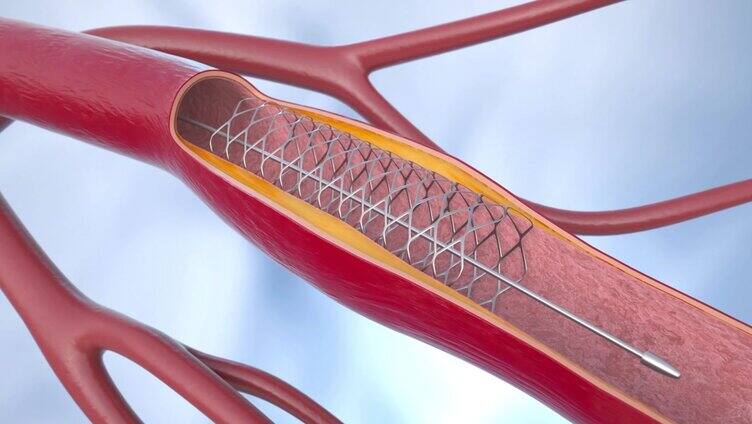 冠状动脉血管成形术