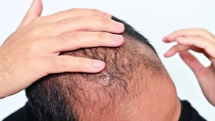 亚洲秃顶男子头皮发痒的问题。