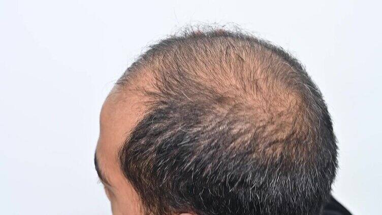 亚洲秃顶男子头皮发痒的问题。