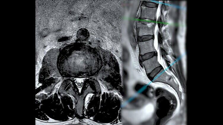 脊柱或腰椎MRI L-S诊断脊髓压迫。