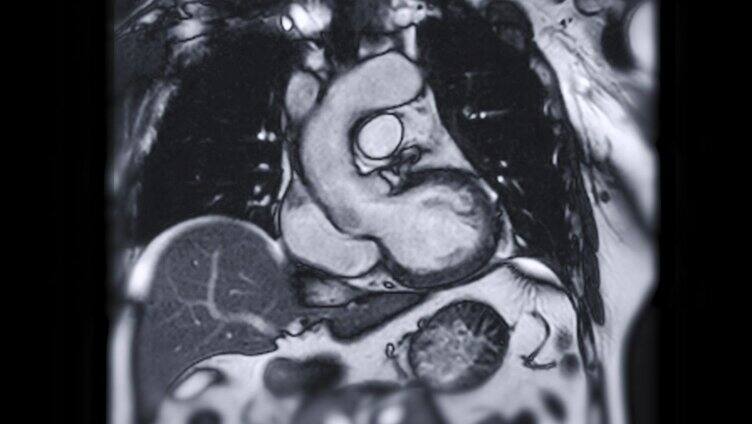 心脏MRI或心脏MRI(磁共振成像)。