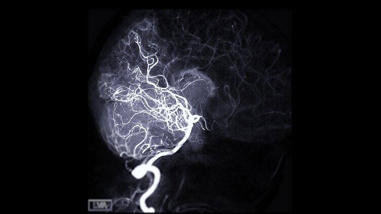 脑血管造影动画