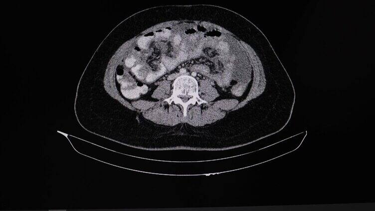 胃癌病人腹部的CT扫描。