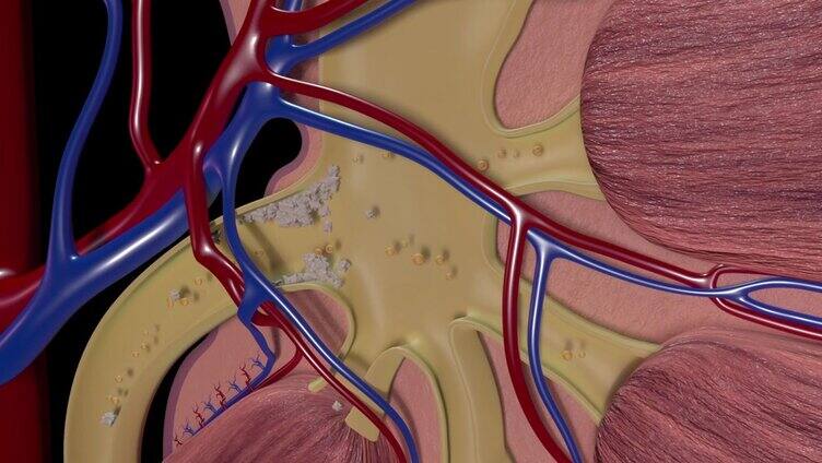 肾结石疾病3D动画