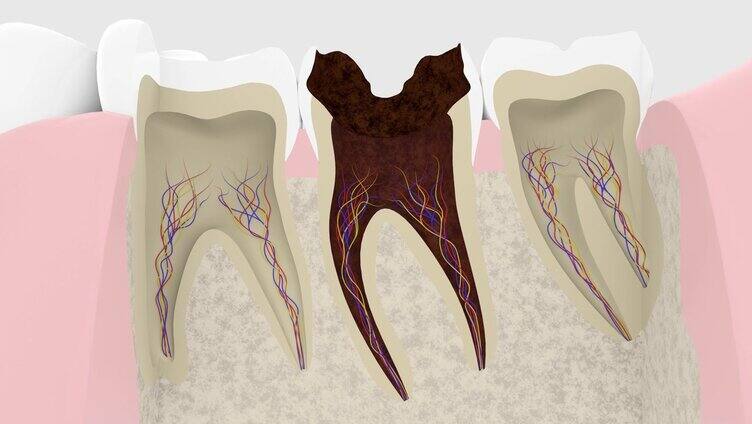 龋齿进展横断面的3D渲染