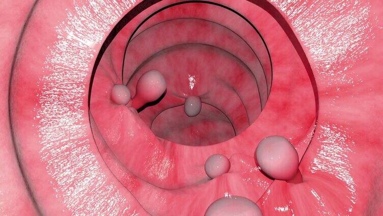 肠息肉概述动画