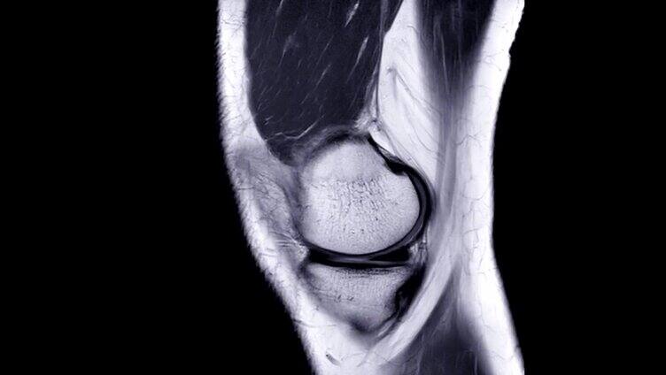 MRI膝关节或磁共振成像膝关节矢状面PDW视图。