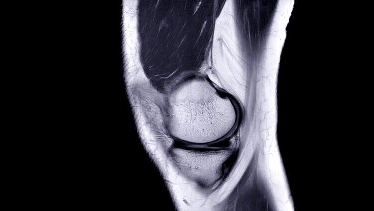 膝关节或磁共振成像膝关节矢状面PDW视图