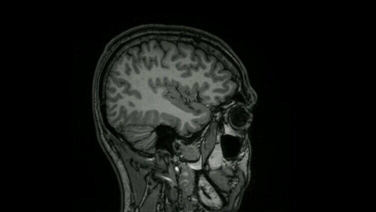 脑部ct扫描外科学 