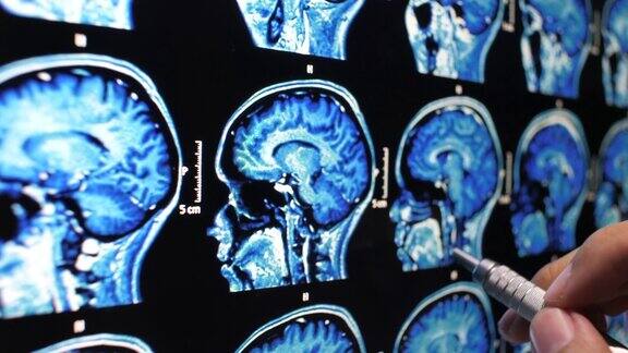 医生检查大脑的核磁共振成像