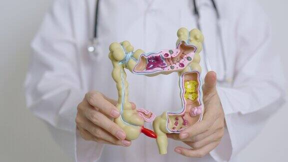 医生用人体结肠解剖模型和片剂结肠疾病大肠结直肠癌溃疡性结肠炎憩室炎肠易激综合征和消化系统