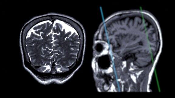 MRI脑冠状T2w斜位可以帮助医生寻找痴呆症的情况
