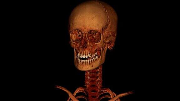 颈动脉CT血管造影