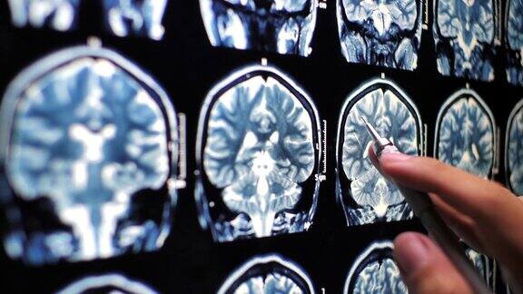 特写医生手检查人脑x光图像