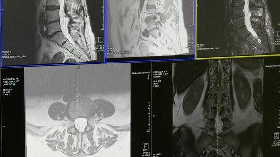 MRI上的脊髓和脊柱断层扫描