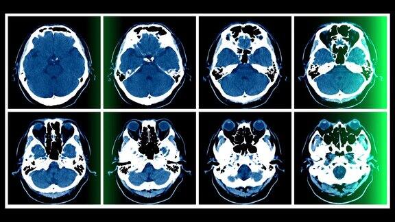 脑部CT影像显示绿光运动