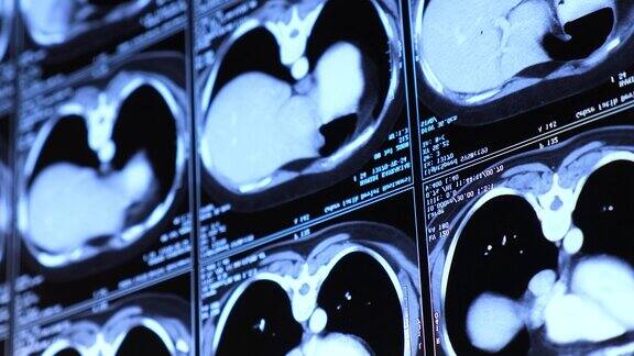 胸部腹部计算机断层扫描(CT)医学、科学和教育CT背景