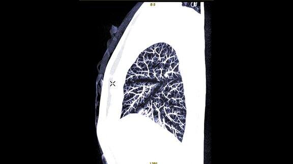 CTA胸部造影剂矢状位MIP图诊断肺栓塞(PE)和肺癌