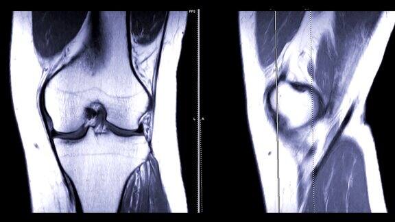 磁共振成像或MRI膝关节冠状面和矢状面对比诊断运动损伤和十字形韧带损伤