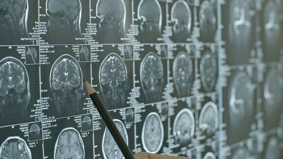 医生指着大脑的核磁共振扫描