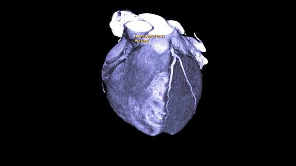 CTA冠脉三维渲染图像或冠脉树在屏幕上旋转用于诊断冠脉狭窄的血管