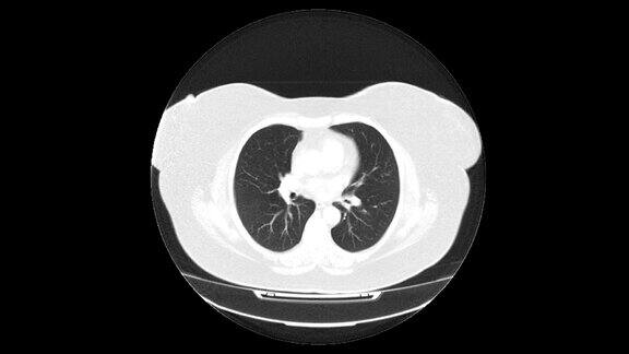 肺、支气管MRI扫描呼吸系统疾病的诊断