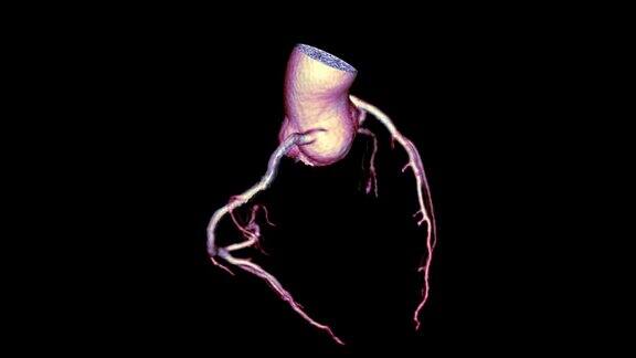 CTA冠脉三维渲染图像或冠脉树在屏幕上旋转用于诊断冠脉狭窄的血管