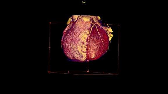 CTA冠状动脉三维渲染图像在屏幕上旋转用于发现心血管疾病