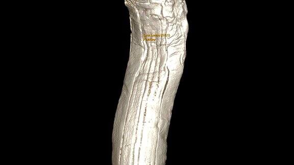 带长腿板的CT膝关节3D渲染图像显示胫骨骨折