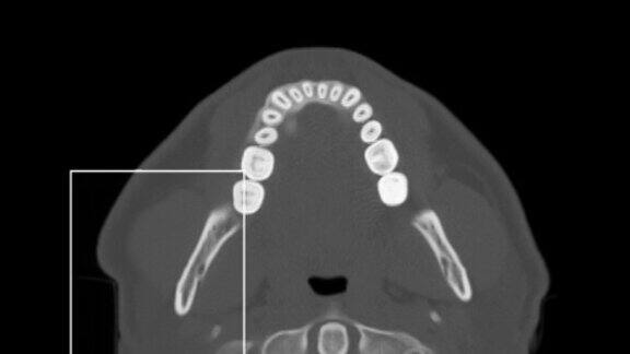 头部和鼻子的迷你CT扫描