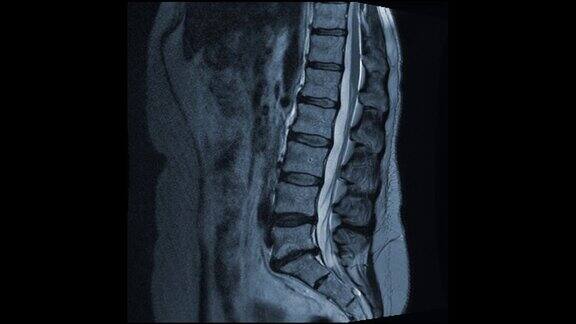 MRI显示L5-S1椎间盘突出