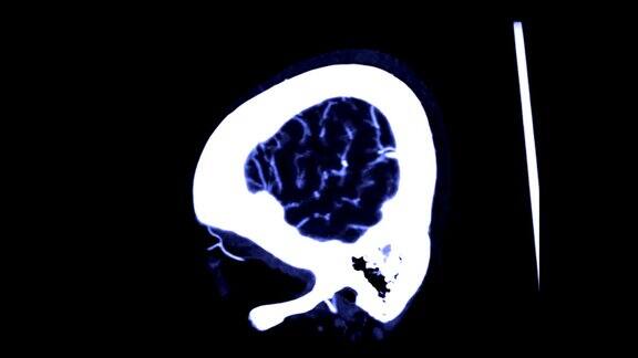 CTA脑或ct血管造影的脑矢状面视图3D渲染图像显示人脑血管