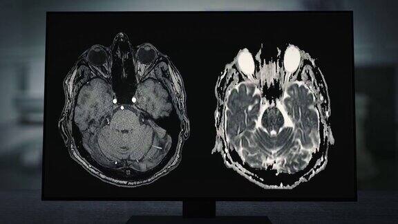 CT脑扫描图像在磁共振成像(MRI)监视器