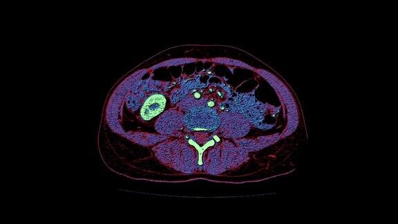 腹腔、胃肠道、膀胱MRI彩色对比