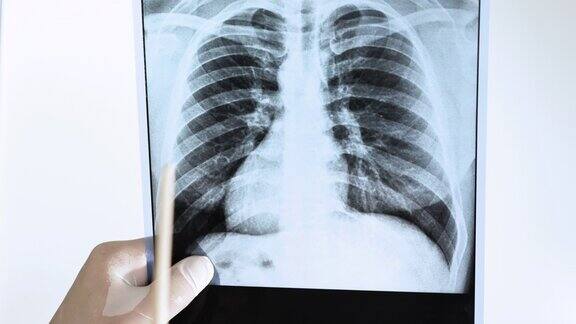 放射科医生-专家在白色背景上分析一个人肺部的x光照片医生用指针指示一个人的肺部疾病肺炎肺部的肺炎Turbeculosis