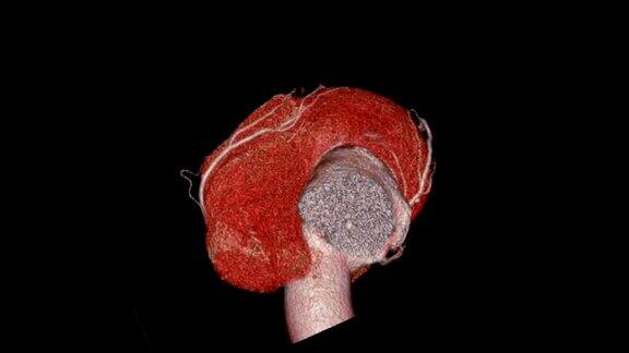 CTA冠状动脉三维渲染图像心脏和血管冠状动脉在屏幕上旋转