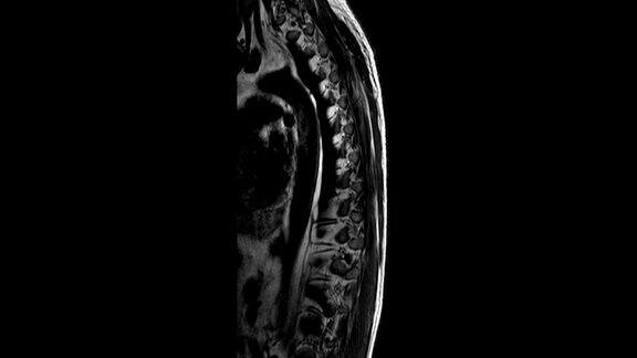 胸脊MRI扫描发现脊柱突出和疝