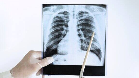 人类肺部x光片上的肺结核医生在白底上分析肺部的x光照片