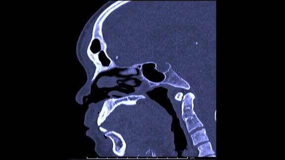 CT脑部矢状面扫描
