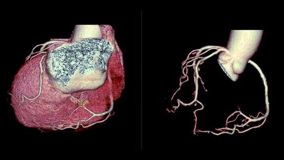 CTA冠状动脉三维渲染图像对比心脏三维和冠状动脉三维在屏幕上旋转用于血管冠状动脉狭窄的诊断