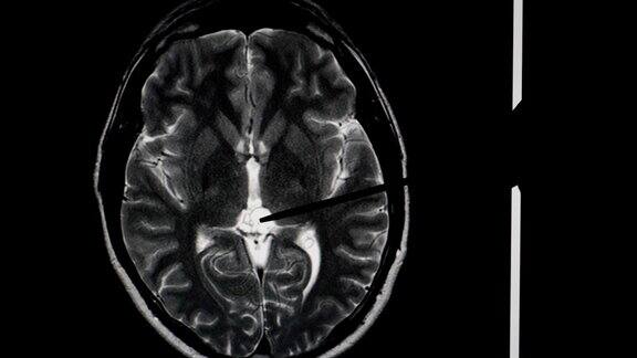 核磁共振大脑扫描