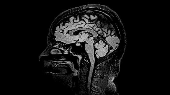 MRI脑部扫描对大脑进行磁共振成像
