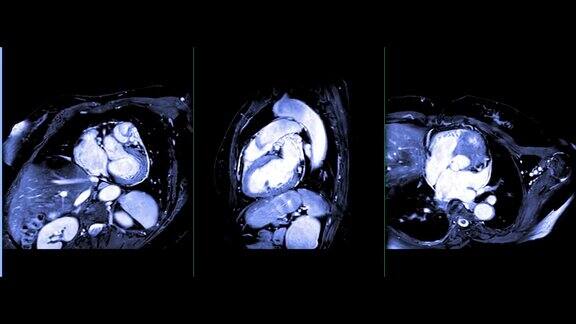 心脏MRI或心脏MRI(磁共振成像)在心脏平面显示心脏工作以检测心脏病