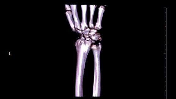 左腕关节CT扫描三维渲染图像在黑色背景旋转尺骨骨折医疗技术