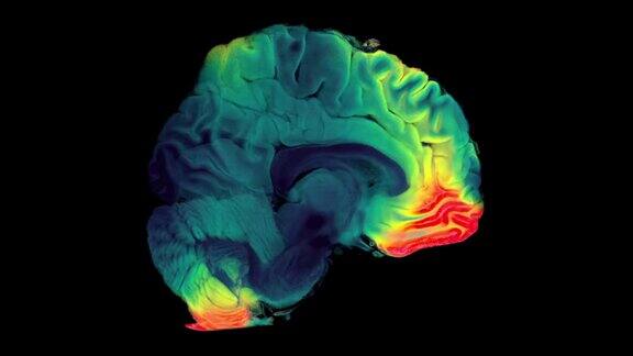 MRA脑或磁共振血管造影术的脑轴向MIP视图显示大脑动脉
