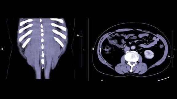 CT上腹部对比冠状位和轴位