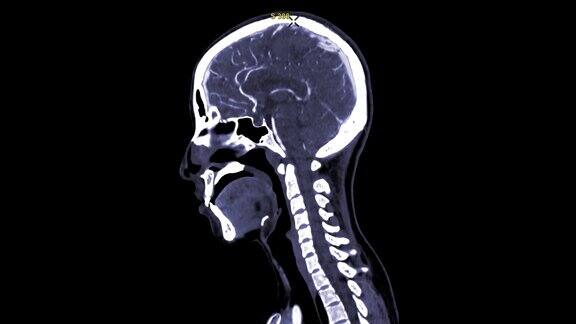 CTA脑或CT脑矢状面缓慢运动并注射造影剂诊断动脉疾病
