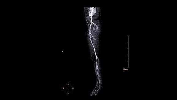 CTA股动脉运行3D渲染画面显示下肢血管股动脉