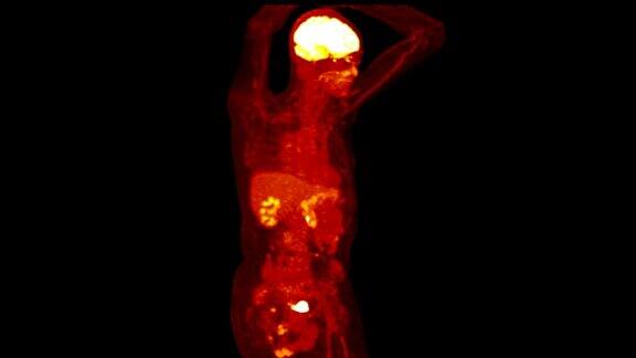 PETCT(PositronEmissionTomography正电子发射断层扫描)的全身三维渲染图像为红色